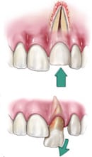 Dislodged Luxated Teeth