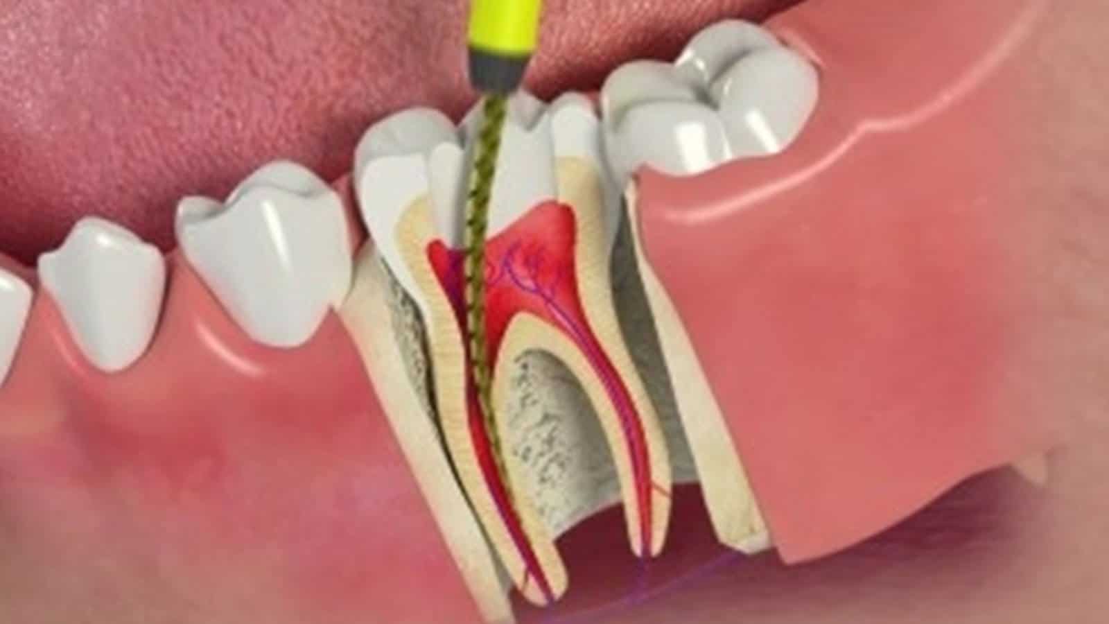 root-canal-yorkhill-endodontics