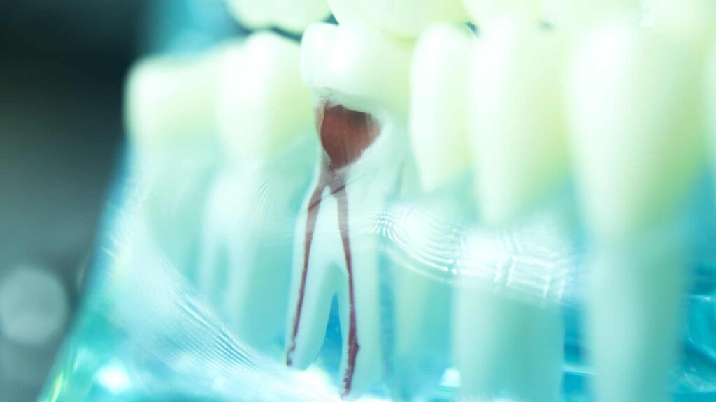 dental tooth root canal