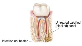 Endodontic Re-Treatment